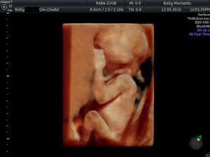 16 wks Pregnancy scan swindon